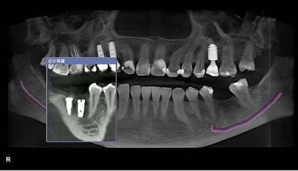 植牙術前口腔完整評估,安全有保障 植牙術前口腔完整評估,安全有保障