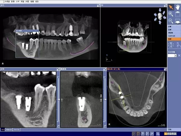 植牙術前口腔完整評估,安全有保障 植牙術前口腔完整評估,安全有保障