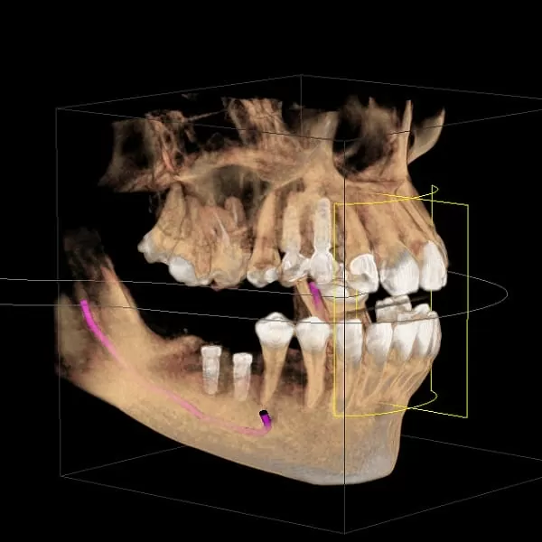 植牙術前口腔完整評估,安全有保障 植牙術前口腔完整評估,安全有保障