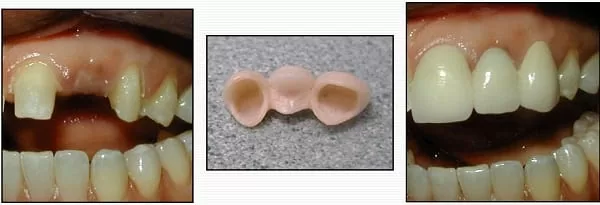 我缺牙了!植牙、牙橋、活動假牙? 哪種好?(江禎基醫師) 我缺牙了!植牙、牙橋、活動假牙? 哪種好?(江禎基醫師)