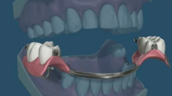 我缺牙了!植牙、牙橋、活動假牙? 哪種好?(江禎基醫師) 我缺牙了!植牙、牙橋、活動假牙? 哪種好?(江禎基醫師)