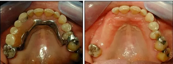 我缺牙了!植牙、牙橋、活動假牙? 哪種好?(江禎基醫師) 我缺牙了!植牙、牙橋、活動假牙? 哪種好?(江禎基醫師)