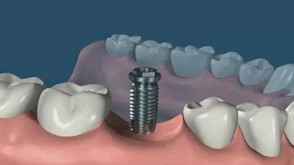 我缺牙了!植牙、牙橋、活動假牙? 哪種好?(江禎基醫師) 我缺牙了!植牙、牙橋、活動假牙? 哪種好?(江禎基醫師)