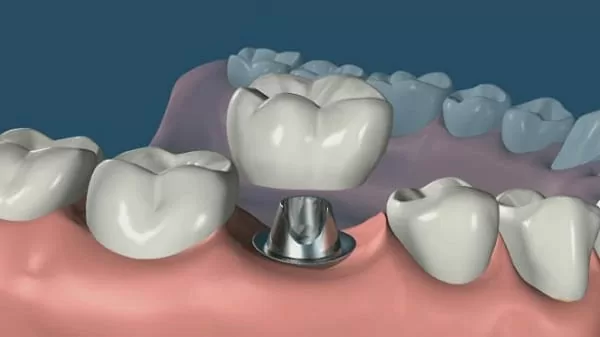 我缺牙了!植牙、牙橋、活動假牙? 哪種好?(江禎基醫師) 我缺牙了!植牙、牙橋、活動假牙? 哪種好?(江禎基醫師)