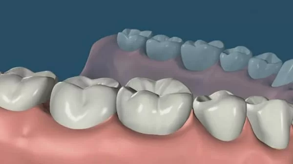 我缺牙了!植牙、牙橋、活動假牙? 哪種好?(江禎基醫師) 我缺牙了!植牙、牙橋、活動假牙? 哪種好?(江禎基醫師)