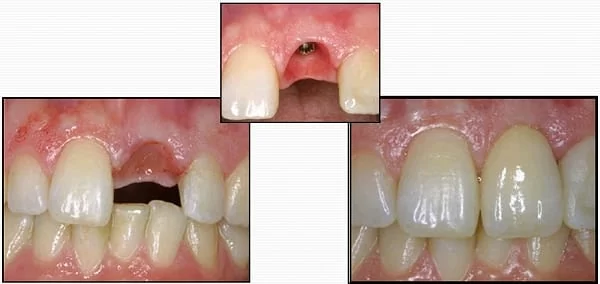 我缺牙了!植牙、牙橋、活動假牙? 哪種好?(江禎基醫師) 我缺牙了!植牙、牙橋、活動假牙? 哪種好?(江禎基醫師)