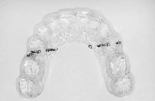 透明隱形矯正器 隱形矯正SOS 透明隱形矯正器 隱形矯正SOS