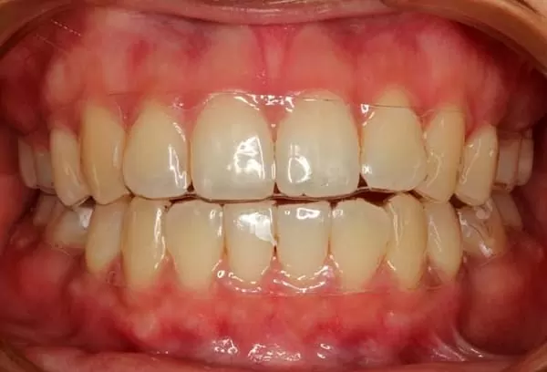 透明隱形矯正器 隱形矯正SOS 透明隱形矯正器 隱形矯正SOS