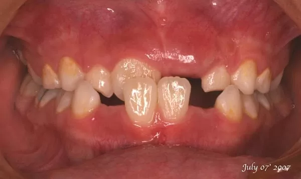 孩子的牙齒不整齊,家長該如何把握兒童矯正黃金期 孩子的牙齒不整齊,家長該如何把握兒童矯正黃金期