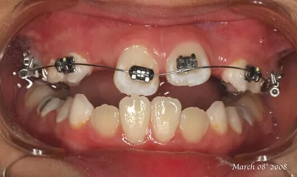 孩子的牙齒不整齊,家長該如何把握兒童矯正黃金期 孩子的牙齒不整齊,家長該如何把握兒童矯正黃金期