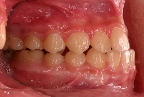 請問牙醫師,在什麼情況下比較適合矯正牙齒? 請問牙醫師,在什麼情況下比較適合矯正牙齒?