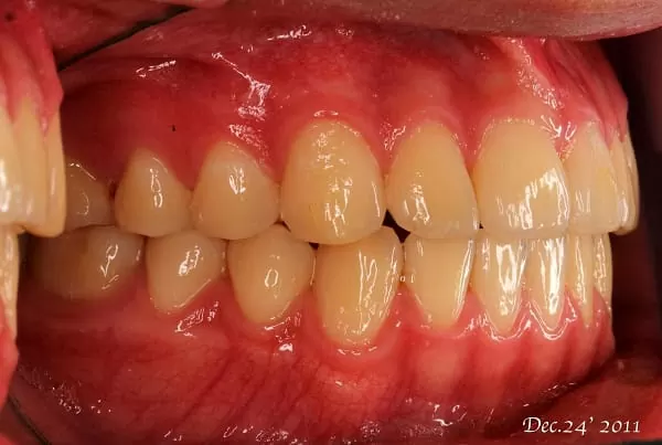 請問牙醫師,在什麼情況下比較適合矯正牙齒? 請問牙醫師,在什麼情況下比較適合矯正牙齒?