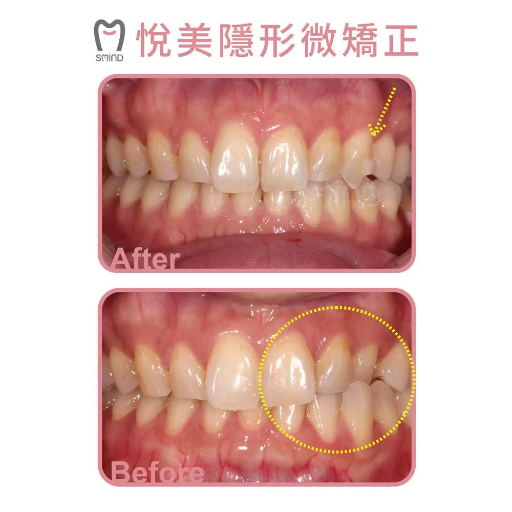 悅美隱形微矯正-錯咬解決方案 悅美隱形微矯正-錯咬解決方案