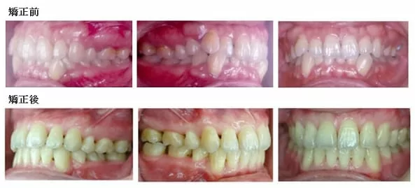 成人齒顎矯正案例