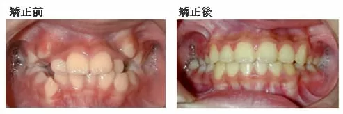 齒列擁擠矯正案例