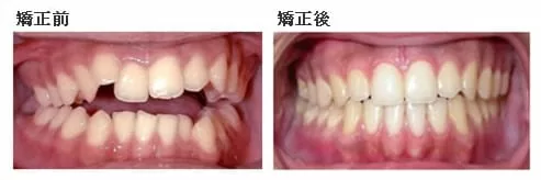 開咬矯正案例