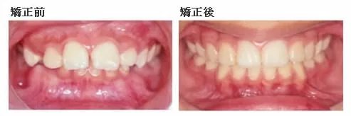 下顎後縮矯正案例