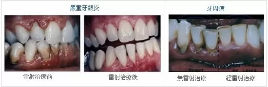 牙周基本治療 (非手術治療)  牙周基本治療 (非手術治療)