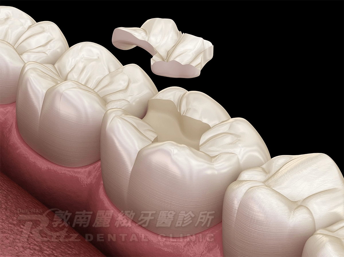 3D齒雕 3D齒雕