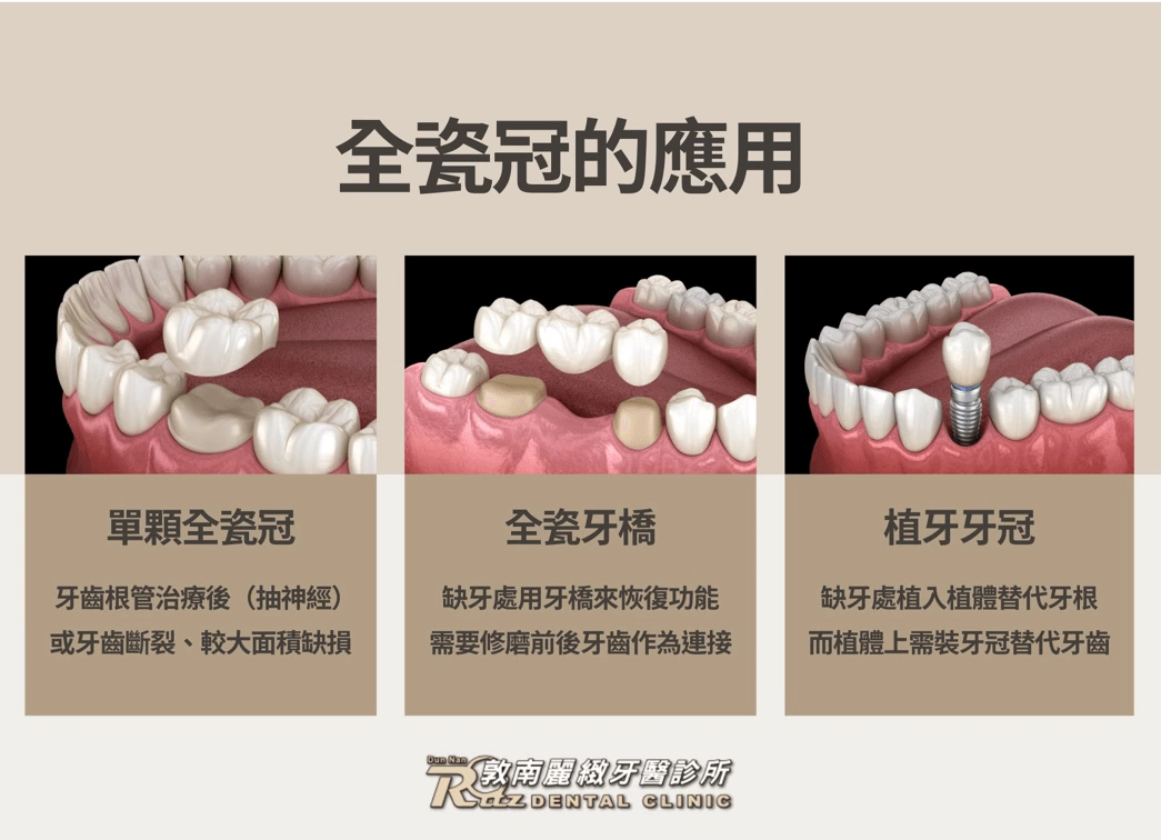 全瓷冠的應用冠 全瓷冠的應用冠