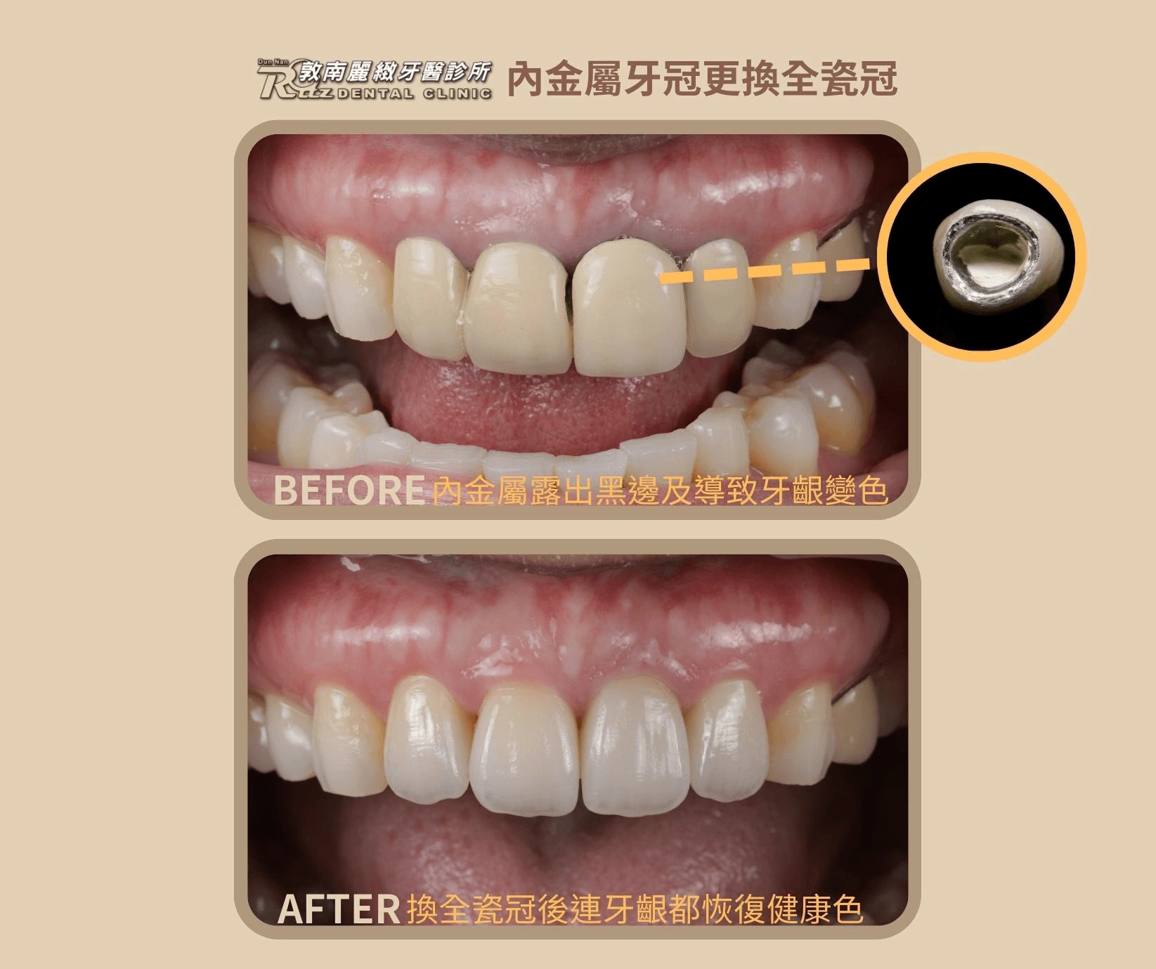 全瓷冠的應用冠 全瓷冠的應用冠