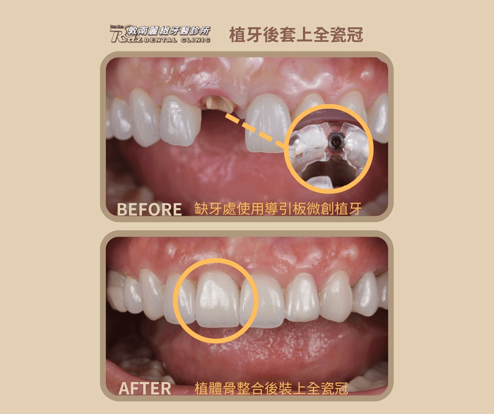 全瓷冠的應用冠 全瓷冠的應用冠