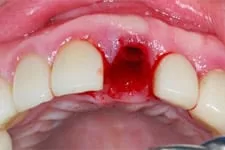 立即植牙 立即植牙