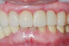 立即植牙 立即植牙