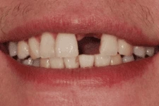 前牙美學植牙 前牙美學植牙