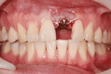 前牙美學植牙 前牙美學植牙