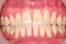 前牙美學植牙 前牙美學植牙