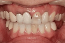 全口重建 全口重建