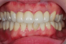 全口重建 全口重建