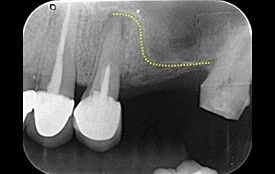 上顎竇增高術 上顎竇增高術