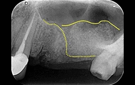 上顎竇增高術 上顎竇增高術
