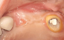 上顎竇增高術 上顎竇增高術