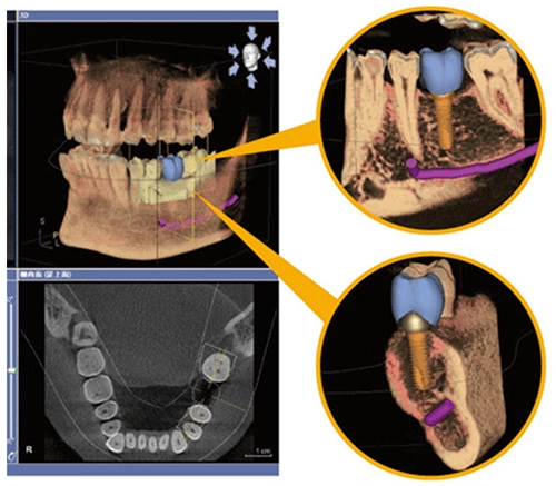 3D數位植牙 3D數位植牙