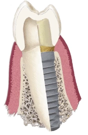 人工植牙術 人工植牙術