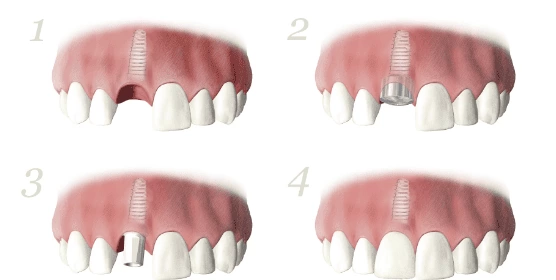 人工植牙療程 人工植牙療程