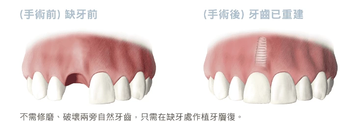人工植牙適應症 - 單顆缺牙 人工植牙適應症 - 單顆缺牙