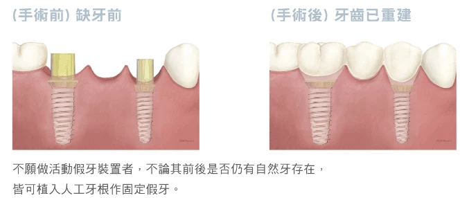 人工植牙適應症 - 多顆缺牙 人工植牙適應症 - 多顆缺牙