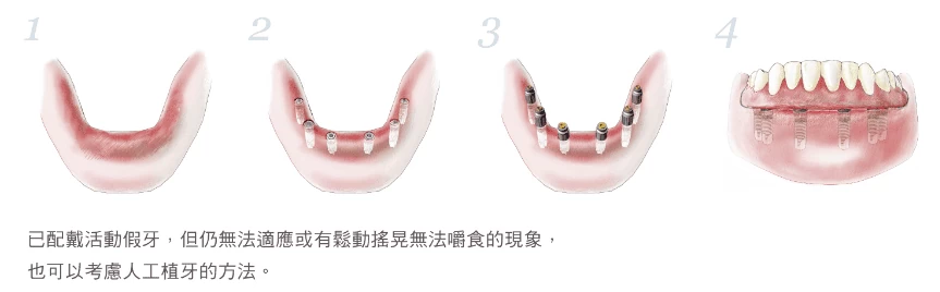 人工植牙適應症 - 全口缺牙 人工植牙適應症 - 全口缺牙