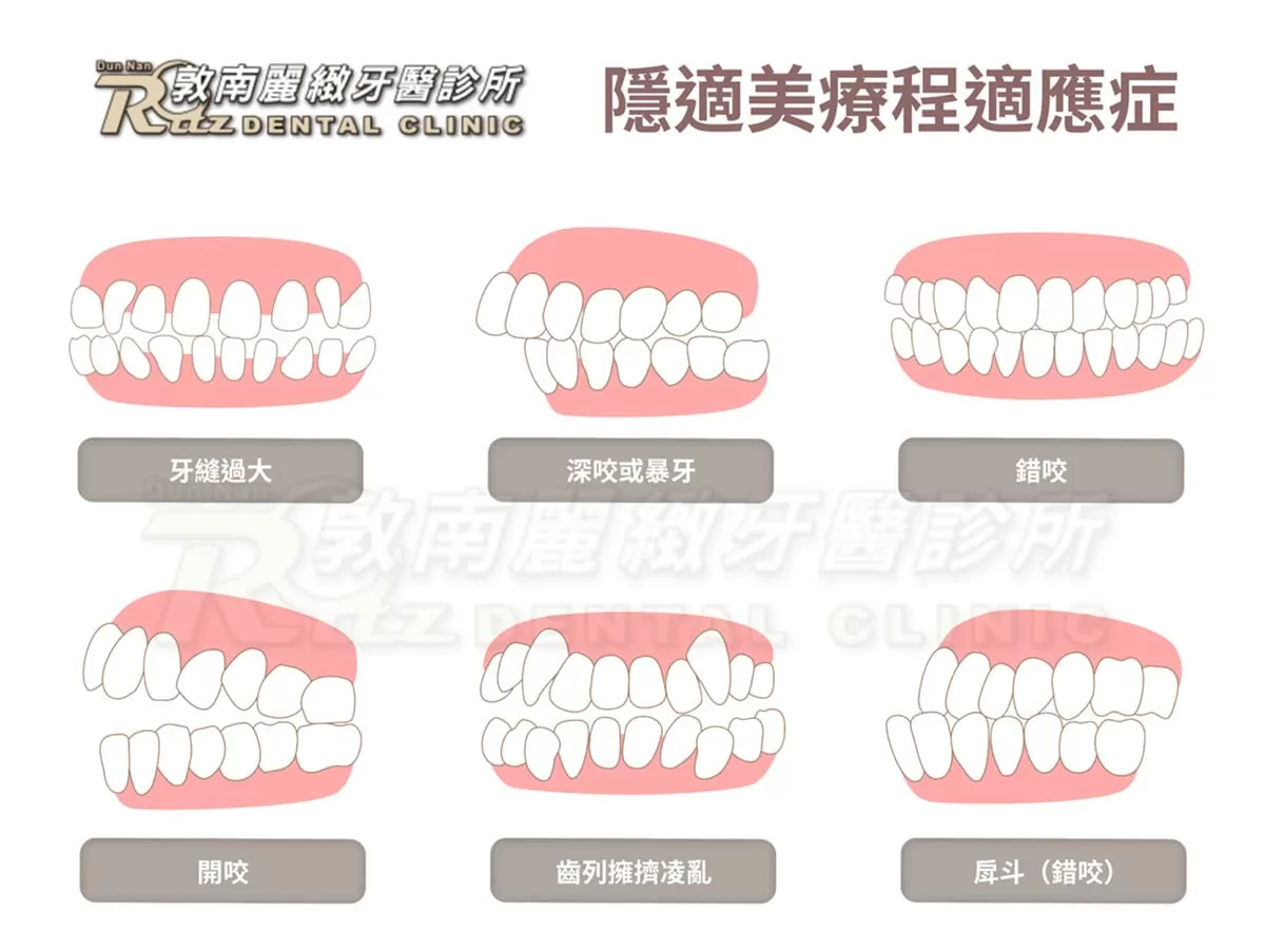 隱適美隱形矯正 隱適美隱形矯正