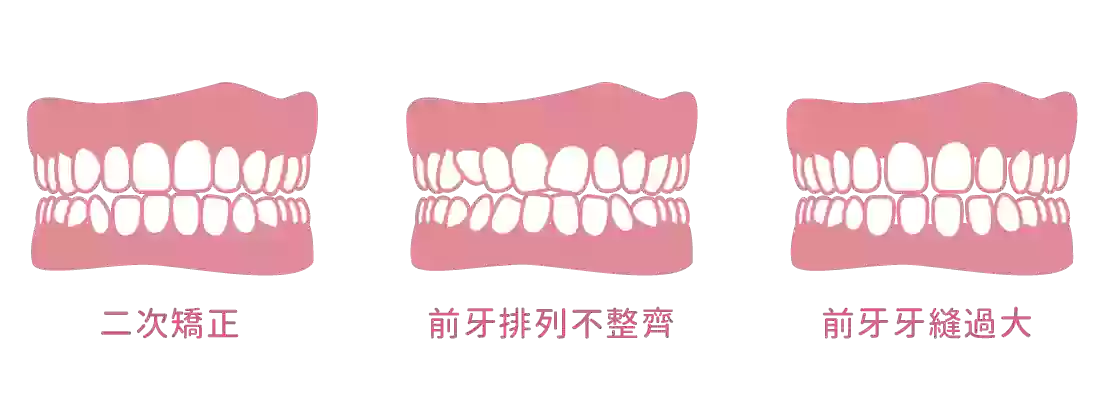 悅美隱形微矯正 悅美隱形微矯正